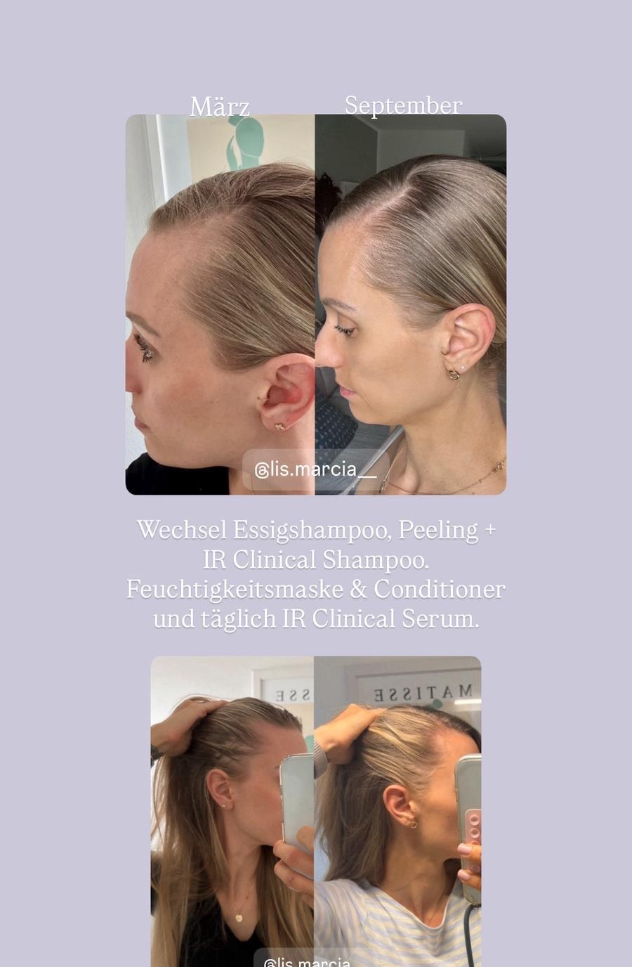 Vorher-Nachher Transformation: Sichtbar dichtere Haare an den Schläfen — @lis.marcia__
