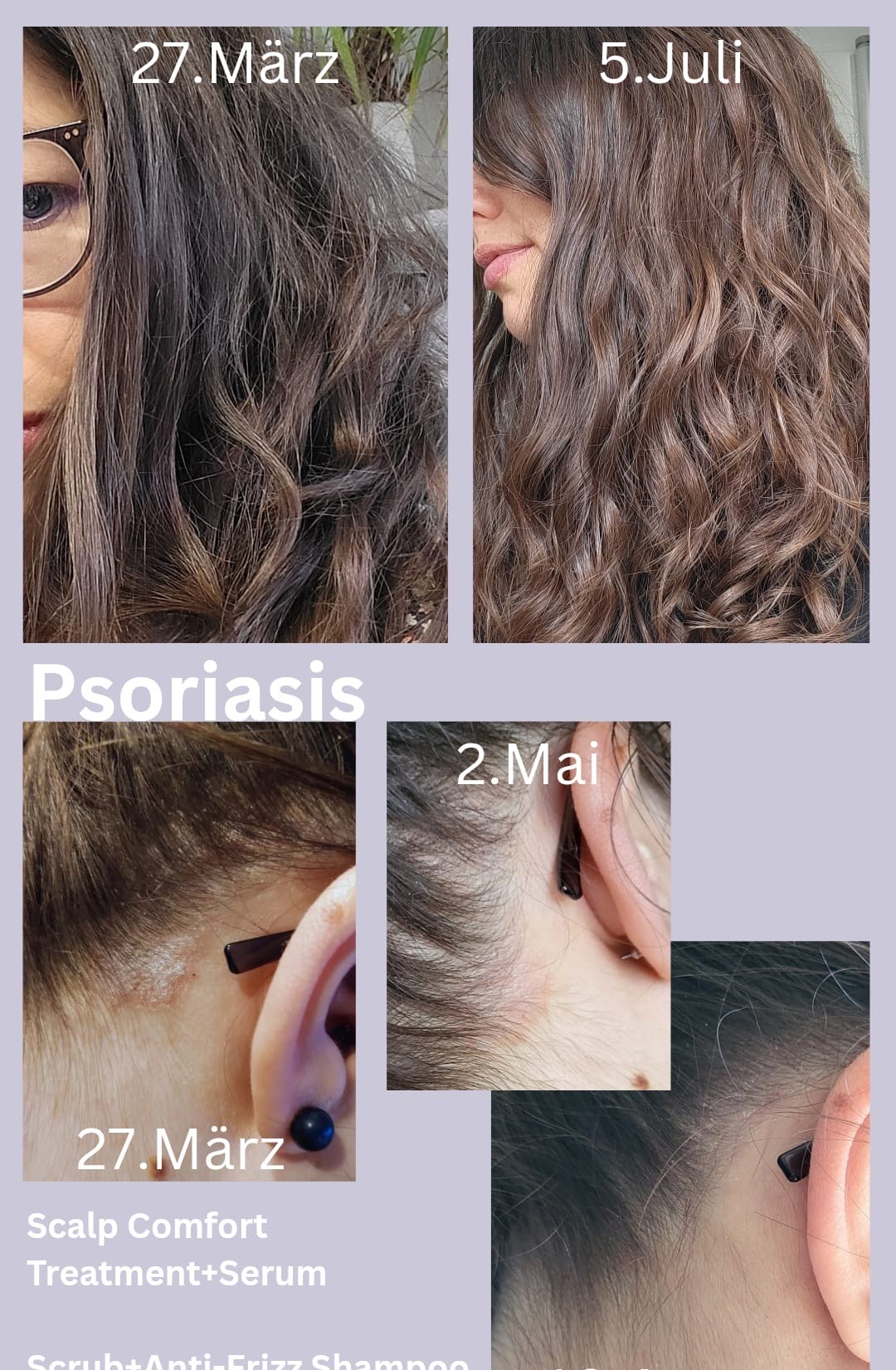 Vorher-Nachher Transformation: Psoriasis beruhigt sich sichtbar — @team_mutimbauch