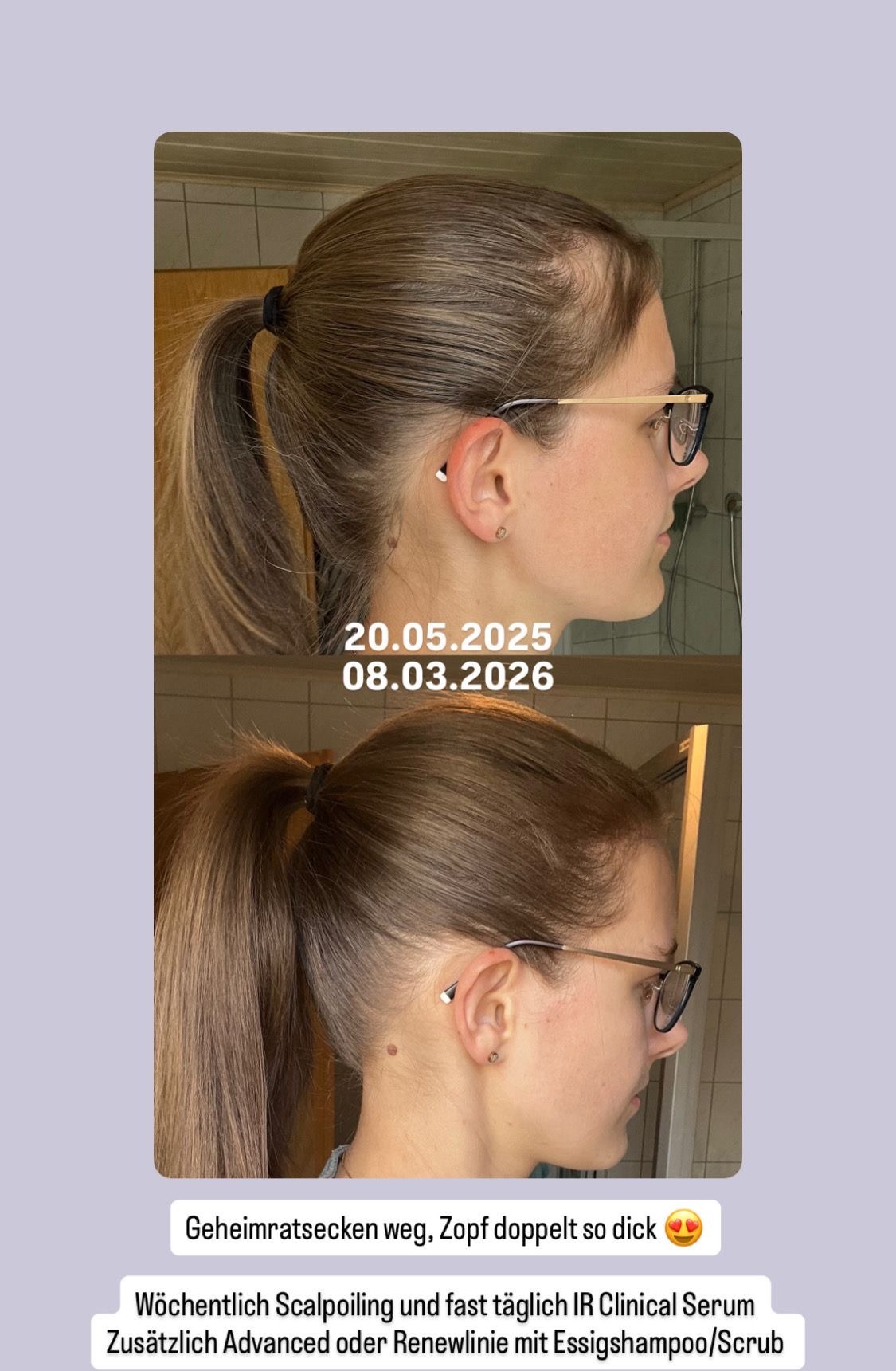 Vorher-Nachher Transformation: Geheimratsecken weg, Zopf doppelt so dick — @dein_haarglueck